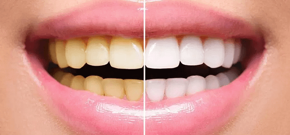 Voito Odontologia - Clareamento Antes depois - Clinica Dentista em Brasília Ceilândia