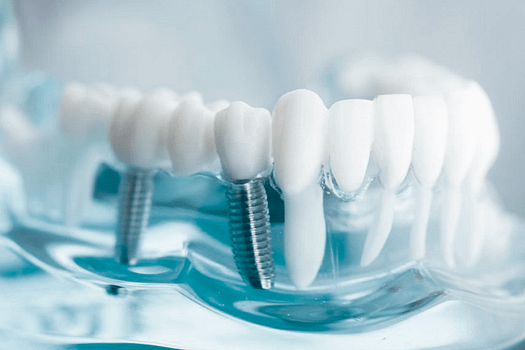 Voito Odontologia - Implante Dental - Clinica Dentista em Brasília Ceilândia