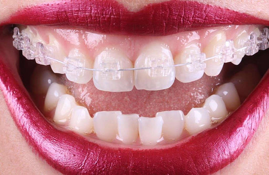 Voito Odontologia - Aparelho Transparente - Clinica Dentista em Brasília Ceilândia